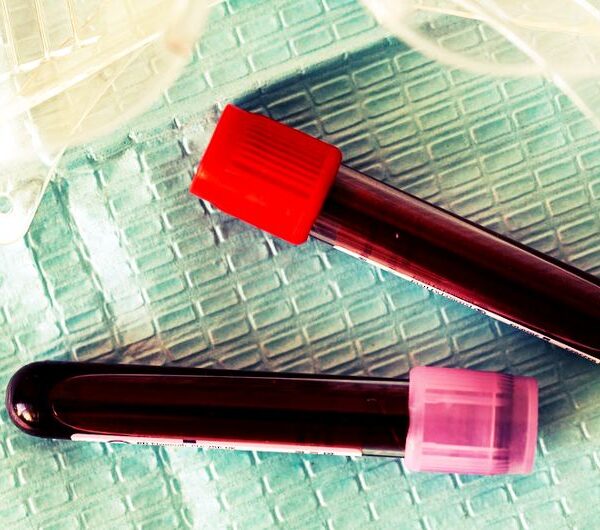 Rajkotupdates.news: EMM-negative-rare-blood-group-found-in-rajkot-man-11th-such-case-worldwide