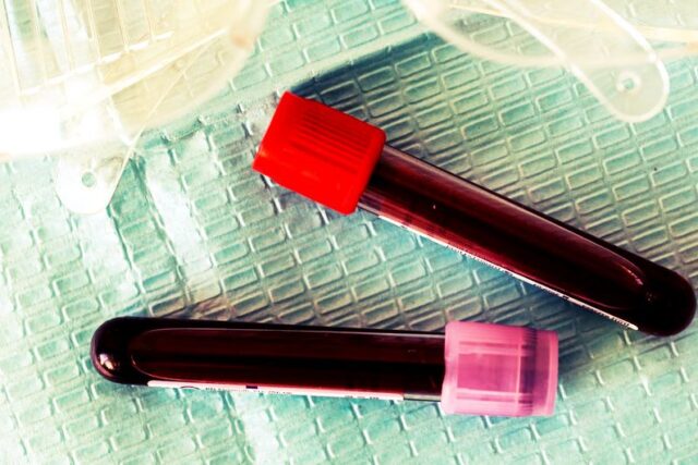 Rajkotupdates.news: EMM-negative-rare-blood-group-found-in-rajkot-man-11th-such-case-worldwide